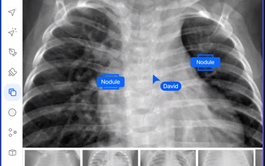 How IMIDEX uses V7 to Detect Pulmonary Nodules, Indicative of Lung Cancer